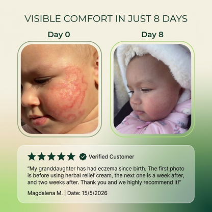 Herbal Psoriasis & Eczema Relief Skin Cream-gm